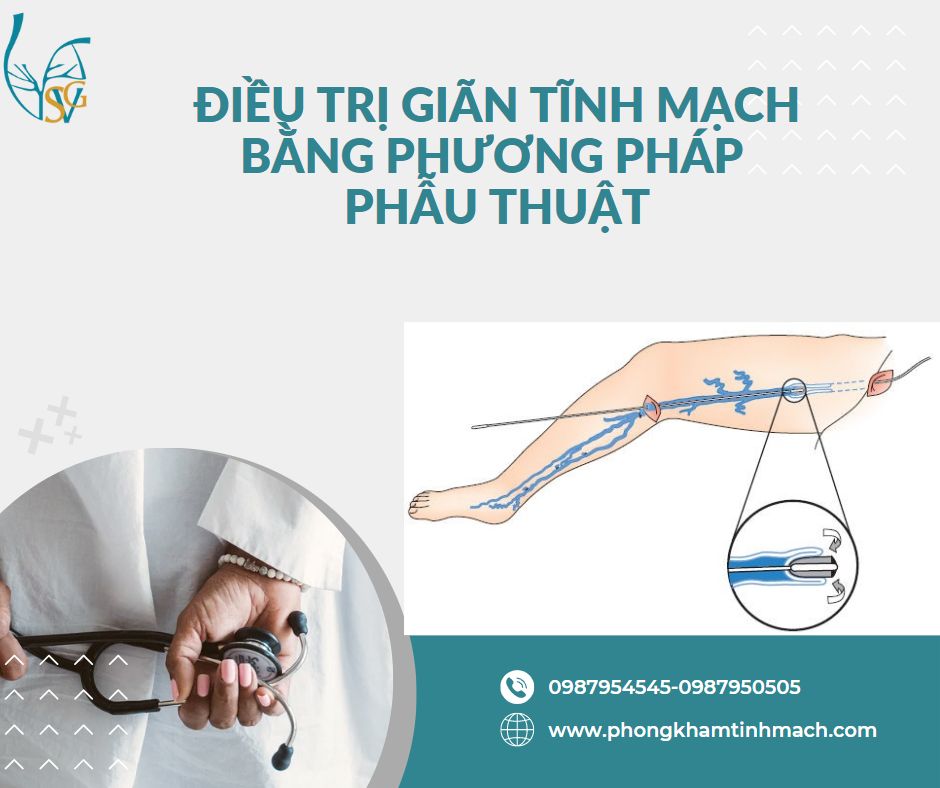 tri gian tinh mach bang phau thuat