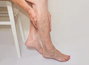 home-remedies-for-varicose-veins
