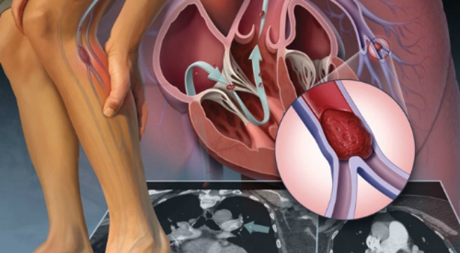 Điều trị bệnh suy giãn tĩnh mạch