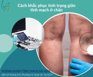 gian tinh mach o chan