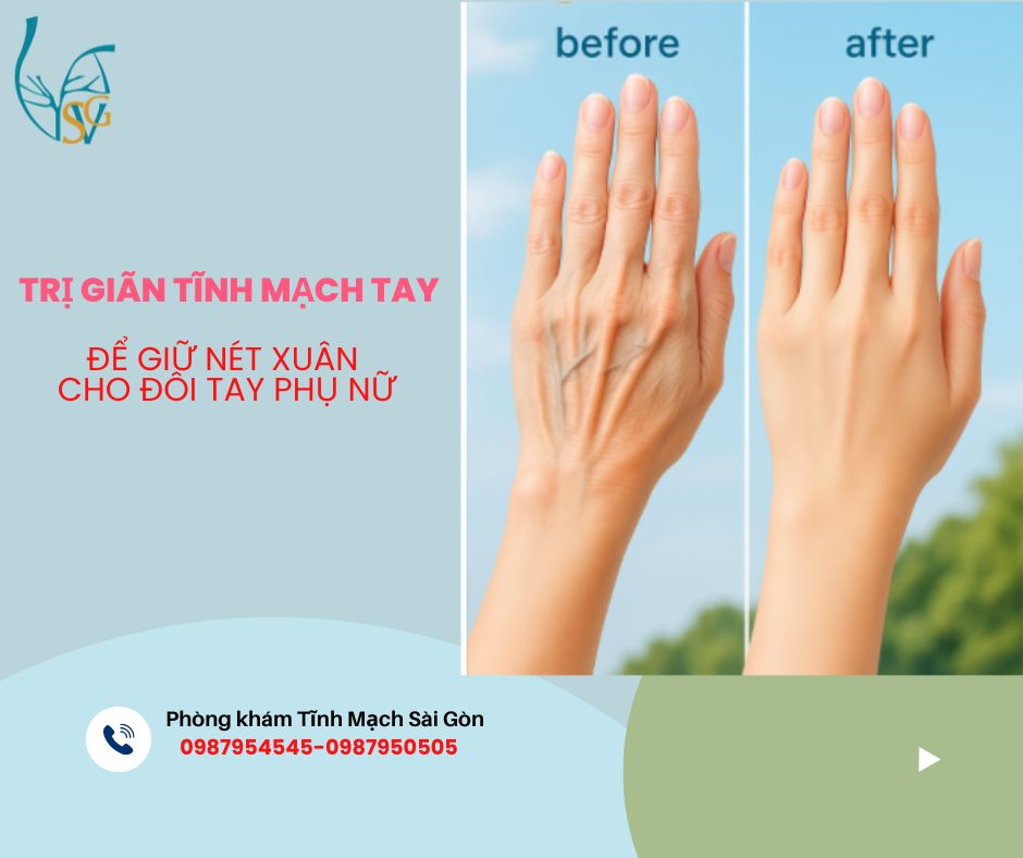 gian tinh mach tay hinh