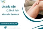dau hieu canh bao benh gian tinh mach