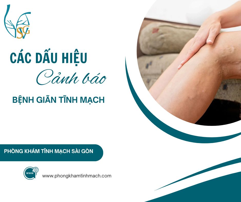dau hieu canh bao benh gian tinh mach